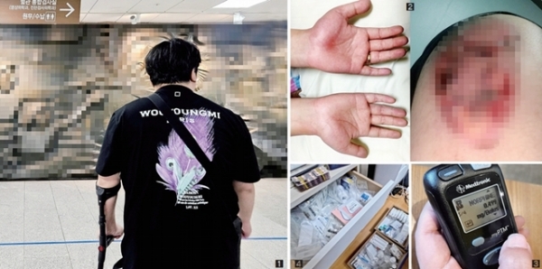 의료 파업으로 인해 희귀 질환자들이 적절한 치료를 받지 못해 심각한 고통과 불편을 겪고 있다. ①희귀질환 복합부위통증증후군(CRPS) 환자인 조민수씨가 진료를 보지 못하고 발길을 돌리는 모습. ②붓고 상처 난 손과 다리. ③마약성 진통제를 주입하는 조씨. ④약으로 가득 찬 서랍.